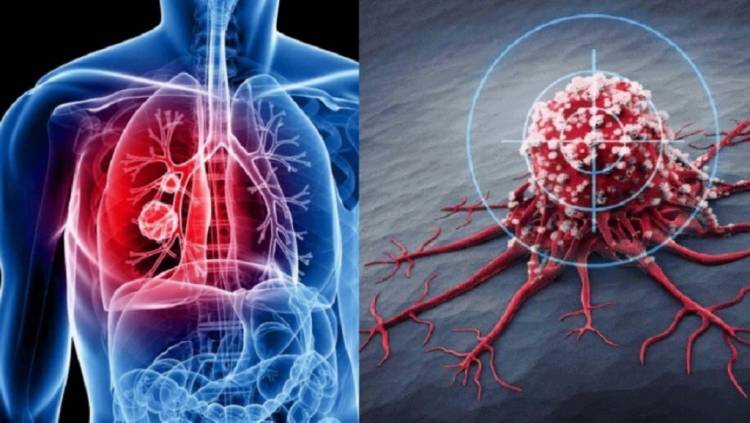 Քաղցկեղի բջիջները «թթու» չեն սիրում. գիտնականների բացահայտումը