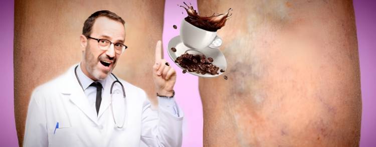 Ինչպես է սուրճն իրականում ազդում երակների վարիկոզ լայնացման վրա․ ինչ են ասում բժիշկները